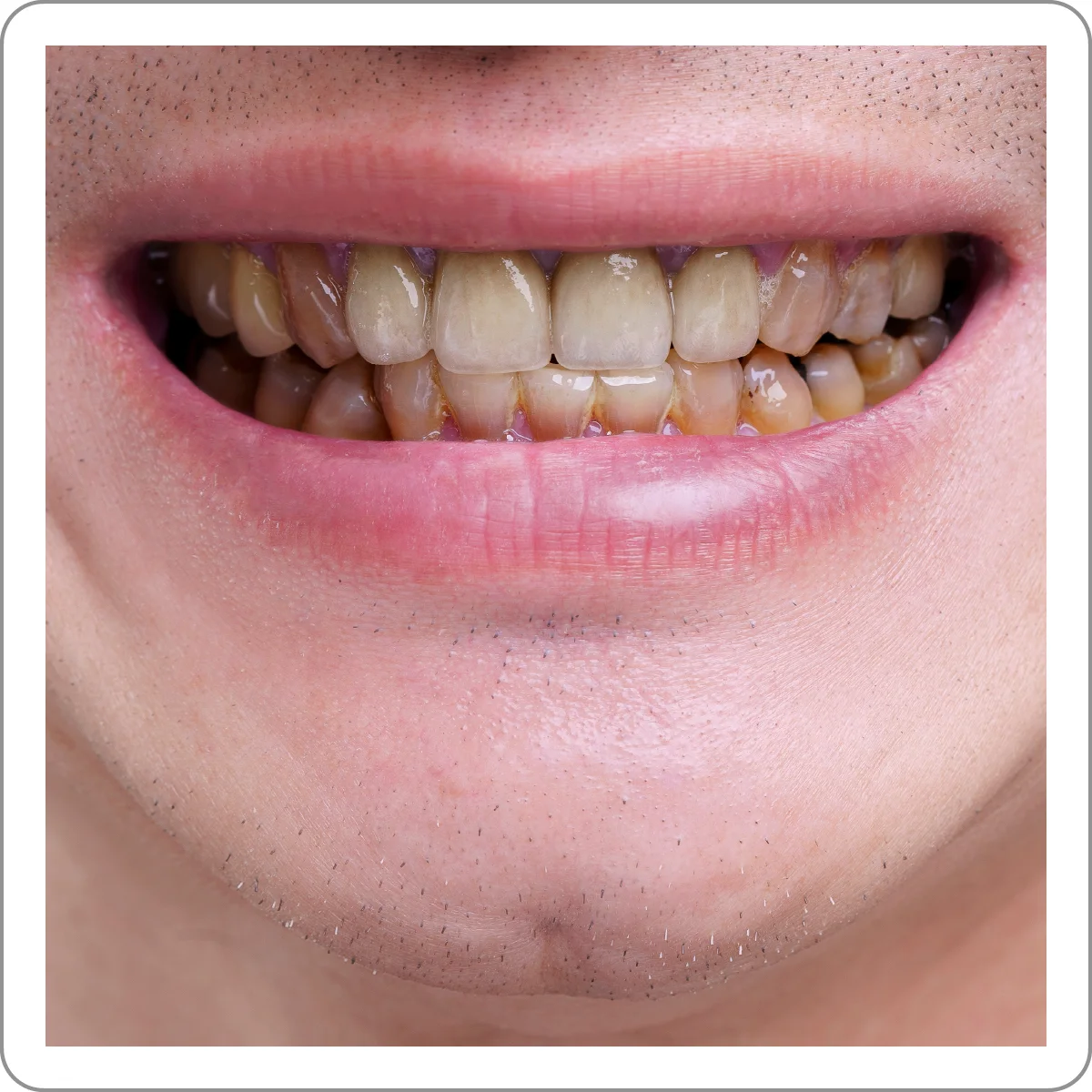 Bọc sứ nguyên hàm thích hợp cho hàm răng bị nhiễm màu nặng